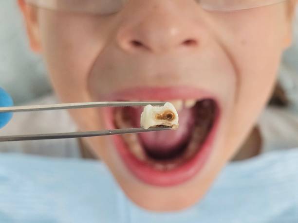 Best Emergency Broken Tooth Repair in Voorheesville, NY